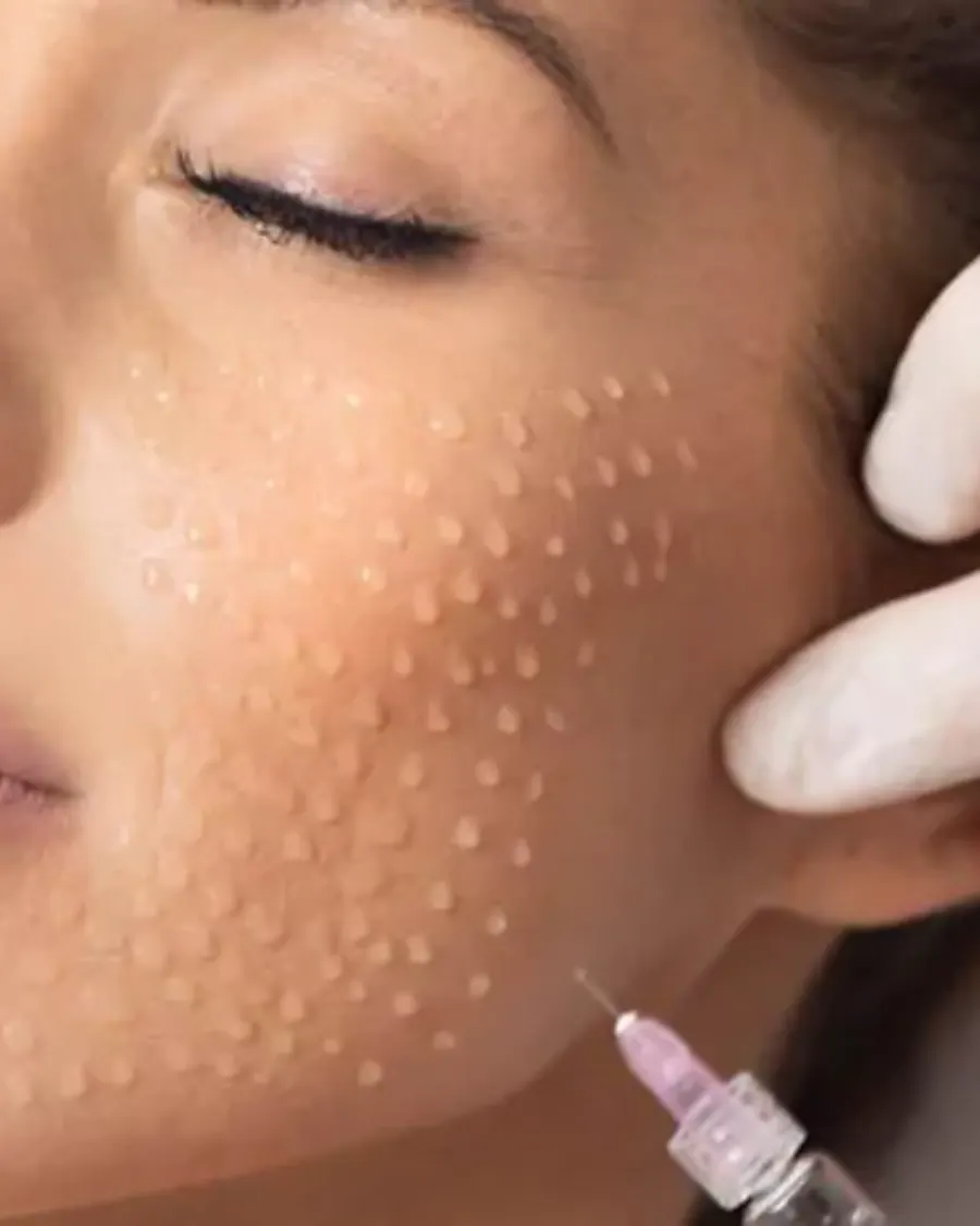 Skin Boosters at Cinch Clinics